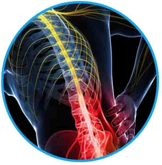 Scoliosis